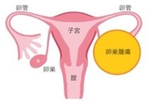 卵巣がんの新薬物療法　患者に適した選択可能に　婦人科（３）　千葉県がんセンター婦人科医長　糸井瑞恵　【９月はがん征圧月間　ちば　がんにうち克つ】（8）