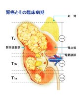 未転移なら手術推奨　近年有効な治療法次々　腎臓がん（腎細胞がん）について　千葉県がんセンター泌尿器科主任医長　小林将行　【９月はがん征圧月間　ちば　がんにうち克つ】（８）