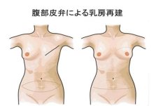 自家組織は形態自然　低侵襲のインプラント　乳房再建術　千葉県がんセンター形成外科部長　徳元秀樹　【９月はがん征圧月間　ちばがんにうち克つ】（１４）