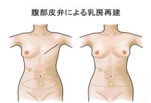 自家組織なら自然に　人工物は他部位傷なく　乳房を再建する手術　千葉県がんセンター形成外科部長　徳元秀樹　【９月はがん征圧月間　ちば　がんにうち克つ】（８）