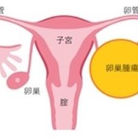 卵巣がんの新薬物療法　患者に適した選択可能に　婦人科（３）　千葉県がんセンター婦人科医長　糸井瑞恵　【９月はがん征圧月間　ちば　がんにうち克つ】（8）