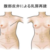 失った乳房取り戻す　専門医の診察受け検討を　乳がん（３）　千葉県がんセンター　形成外科主任医長　徳元秀樹　【ちば　がんにうち克つ】（１３）