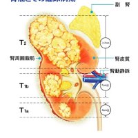 未転移なら手術推奨　近年有効な治療法次々　腎臓がん（腎細胞がん）について　千葉県がんセンター泌尿器科主任医長　小林将行　【９月はがん征圧月間　ちば　がんにうち克つ】（８）