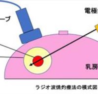 細い針刺し熱で焼灼　心身の負担より少なく　乳がんの切らない治療　千葉県がんセンター乳腺外科医長　羽山晶子　【９月はがん征圧月間　ちば　がんにうち克つ】（１１）