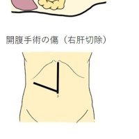 技術進歩で傷小さく　症例次第で開腹手術も　低侵襲手術　千葉県がんセンター肝胆膵外科医長　石毛文隆　【９月はがん征圧月間　ちばがんにうち克つ】（８）
